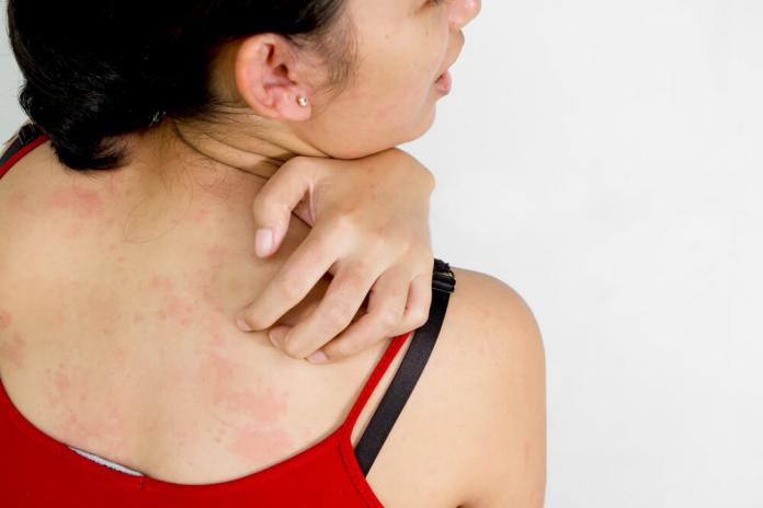 When Should You Worry About a Rash?