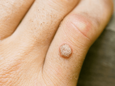 9 Ways To Get Rid Of Foot Calluses And Corns Naturally