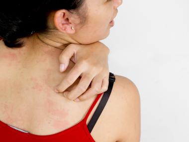 When Should You Worry About a Rash?