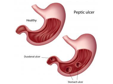 7 Natural Remedies For Ulcers