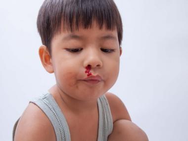 How to Stop a Nosebleed