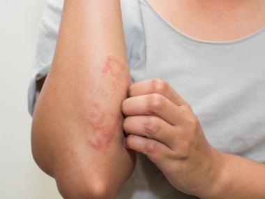 How to Treat and Prevent Eczema