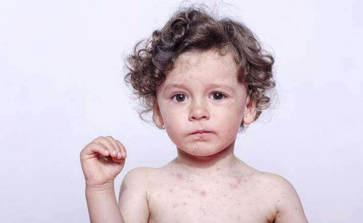 image of child with measles