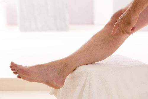 6 Easy Ways To Make Varicose Veins Fade