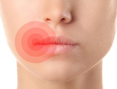 House Call Doctor What Is A Cold Sore Quick And Dirty Tips House Call Doctor What Is A Cold Sore Quick And Dirty Tips