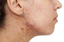 How to Treat Adult Acne