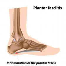 What is Plantar Fasciitis?