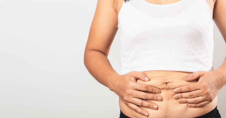 woman holding the loose skin on her stomach