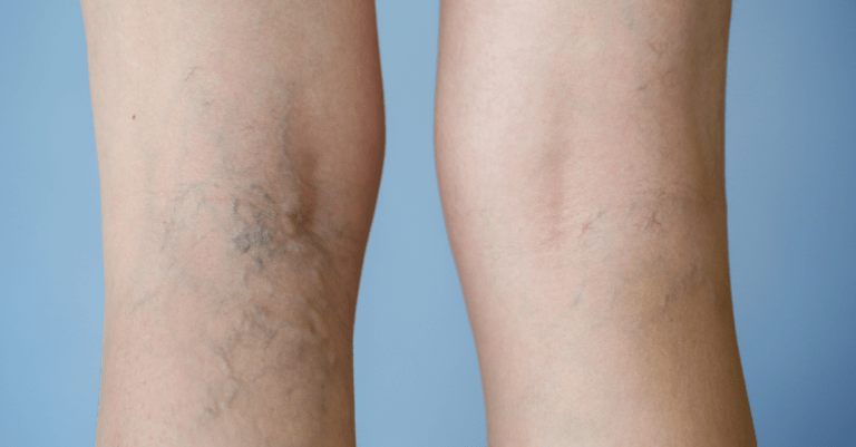 varicose veins seen on the back of legs