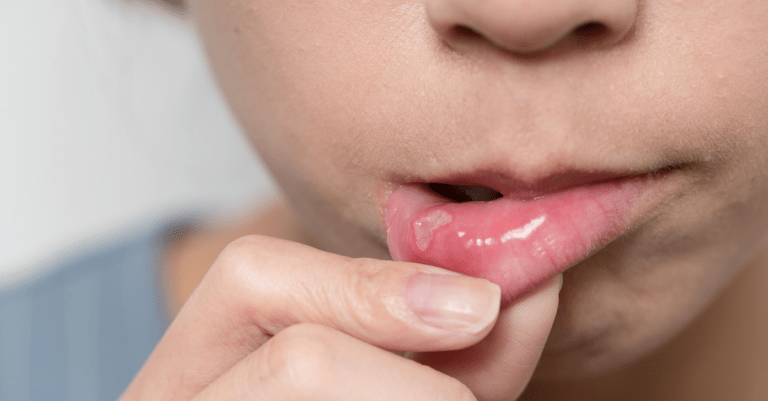 8 Ways to Get Rid of Canker Sores