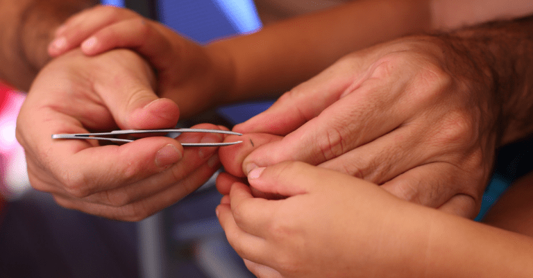 8 Tricks for Removing Splinters