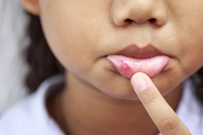 8 Ways to Get Rid of Canker Sores