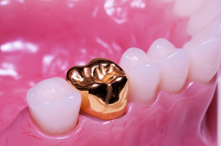 Gold dental crown on white teeth